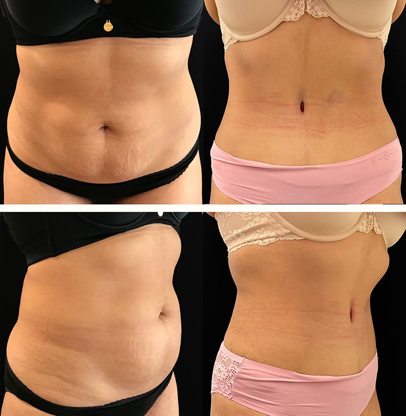 Abdominoplasty+Before+and+After+Patient+103