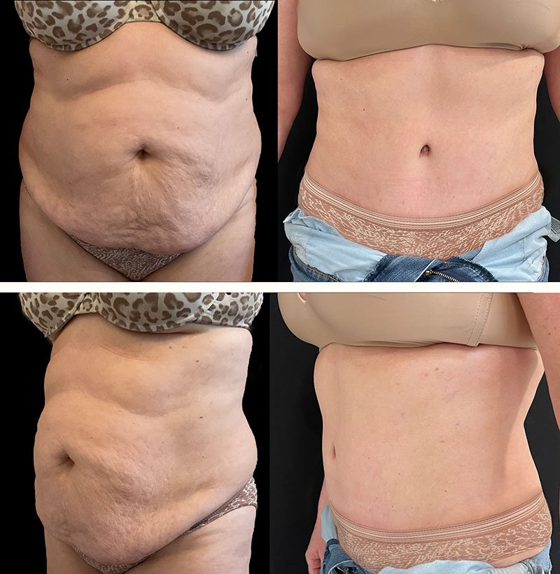 Abdominoplasty+Before+and+After+Patient+221