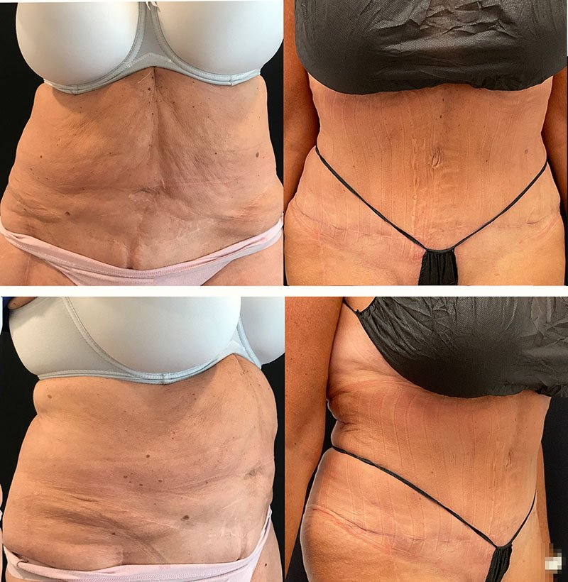 Abdominoplasty+Before+and+After+Patient+35