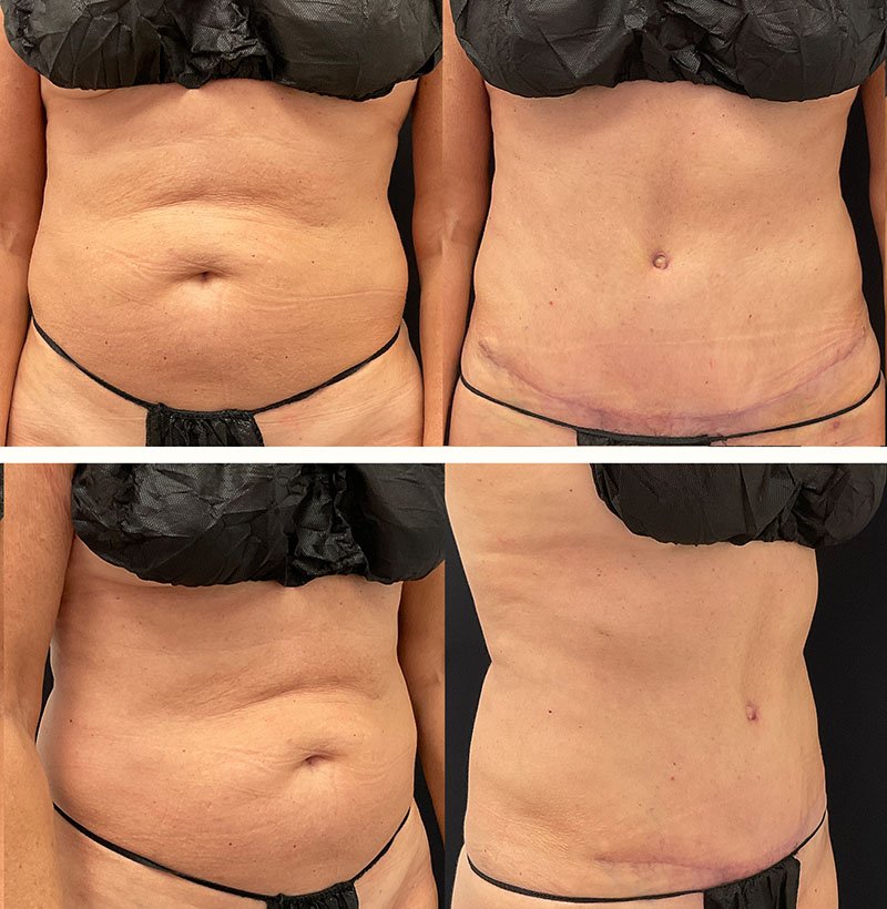 Abdominoplasty+Before+and+After+Patient+78