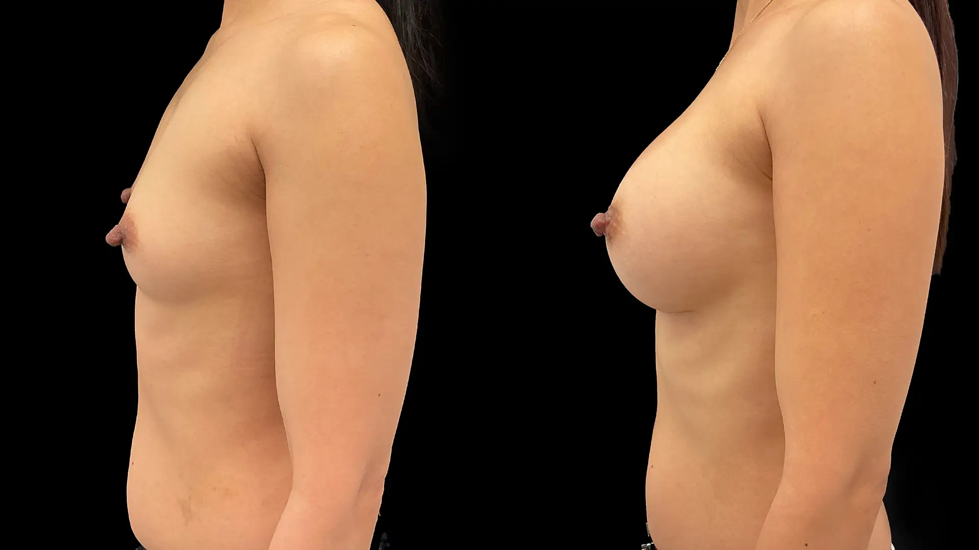 1920 x 1080 Breast Augmentation Before And After L