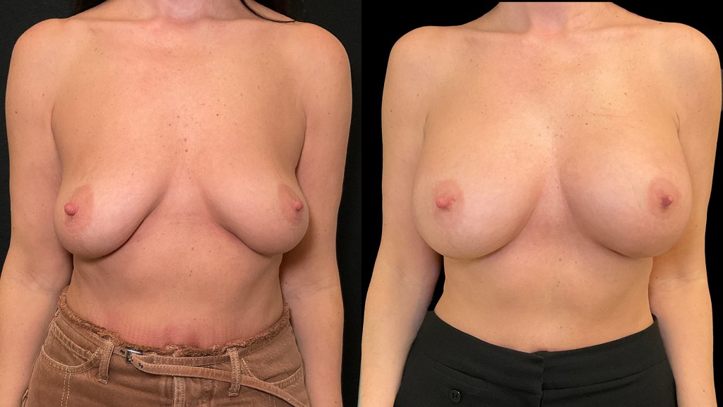 1920 x 1080 Front Before and After Breast Augmentation NJ