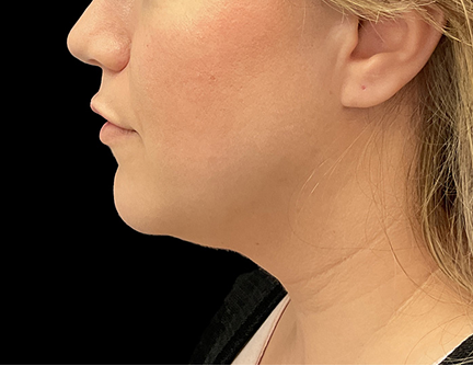 Photo demonstrating a patient's neck and jaw line before facelift surgery