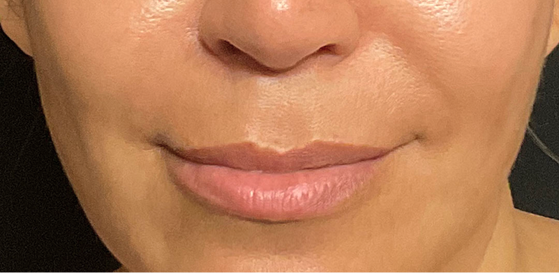 Image of a woman's lips before lip lift surgery