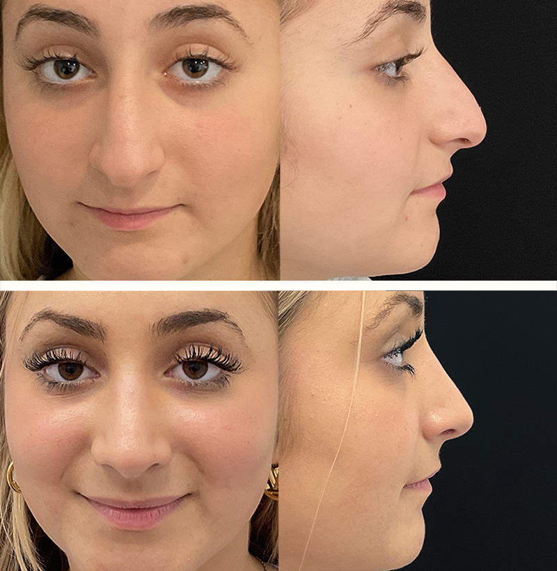 Patient107RhinoplastyBeforeAndAfterGallery