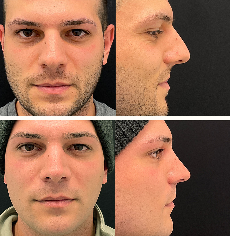 Patient112MaleRhinoplastyBeforeAndAfterGallery