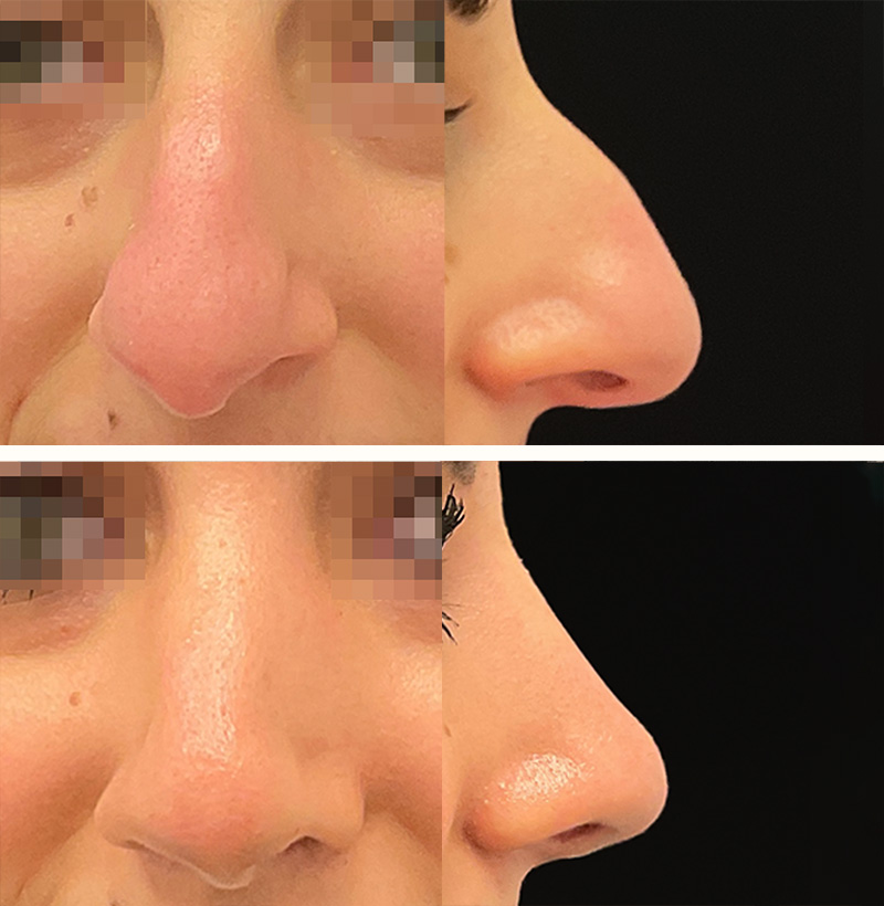 Patient122RhinoplastyBeforeAndAfterGallery