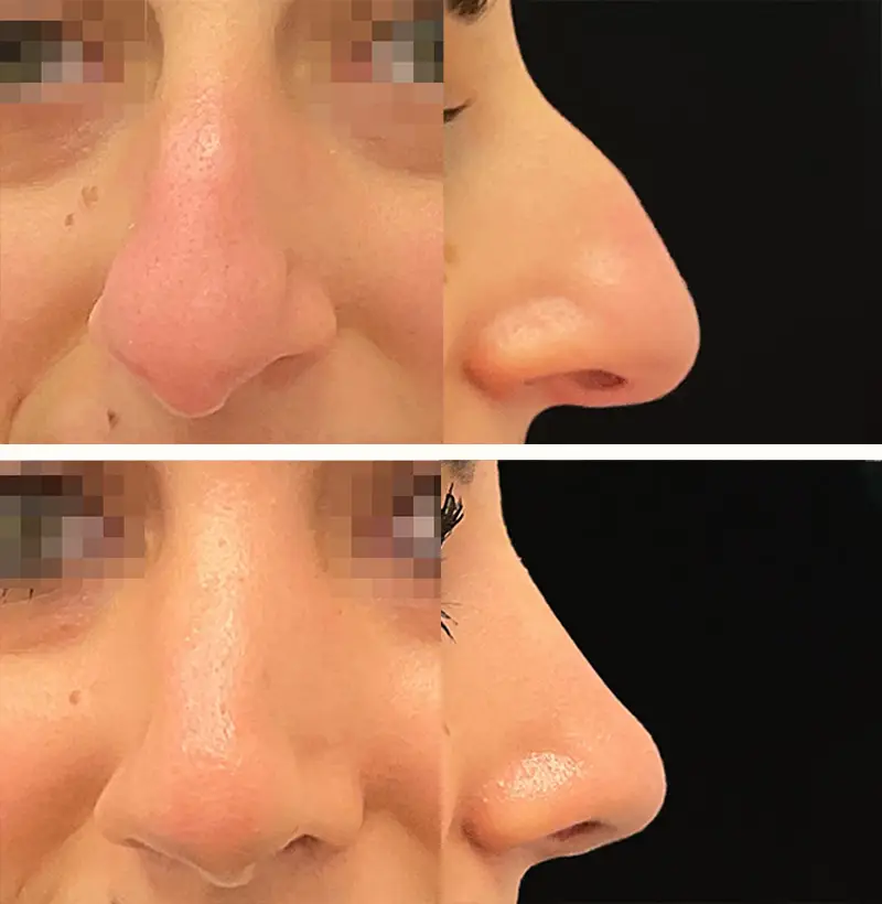 Patient122RhinoplastyBeforeAndAfterGallery