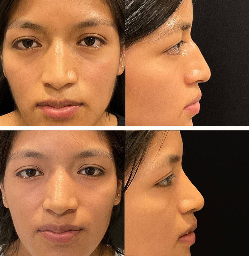 Patient131EthnicRhinoplastyBeforeAndAfterGallery
