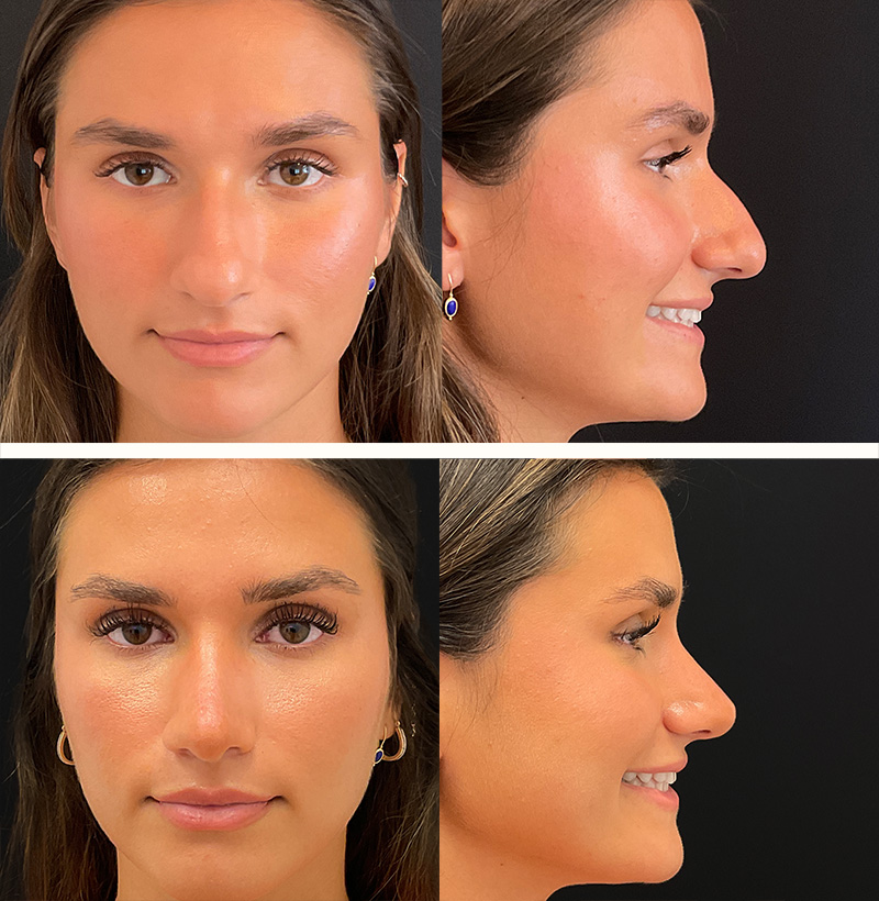 Real patient before and after example of primary rhinoplasty