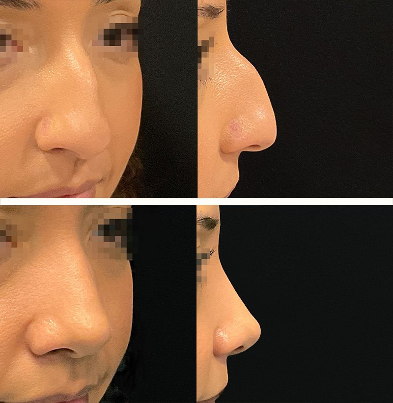 Patient201RhinoplastyBeforeAndAfterGallery (1)