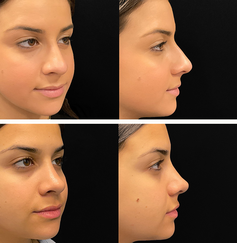 Patient201RhinoplastyBeforeAndAfterGallery