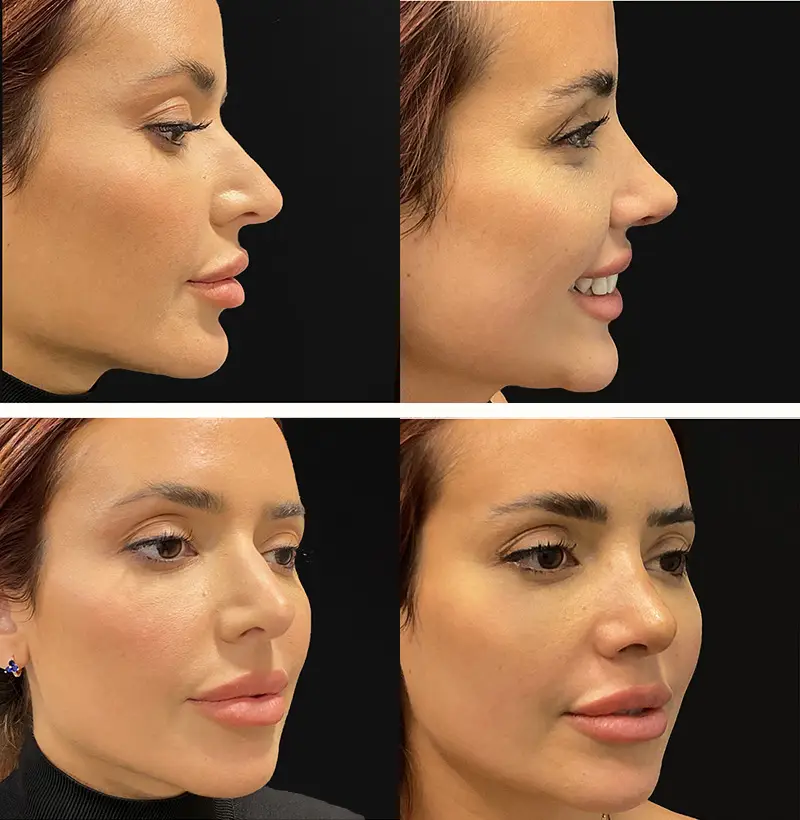 Patient in her early 50s after revision rhinoplasty. Before and after side profile and thee quarter view