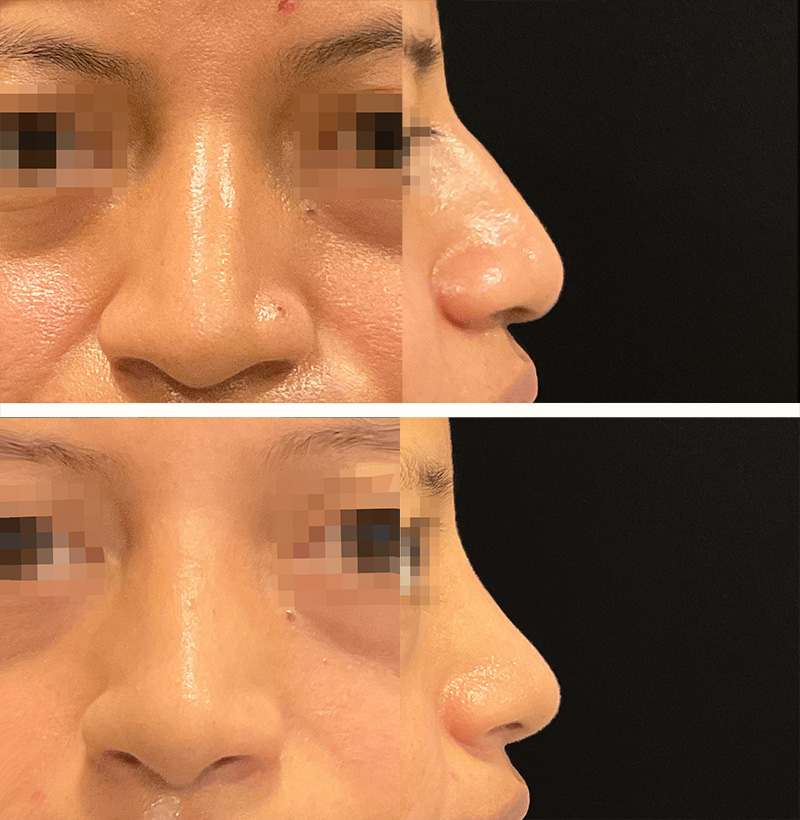 Patient54EthnicRhinoplastyBeforeAndAfterGallery