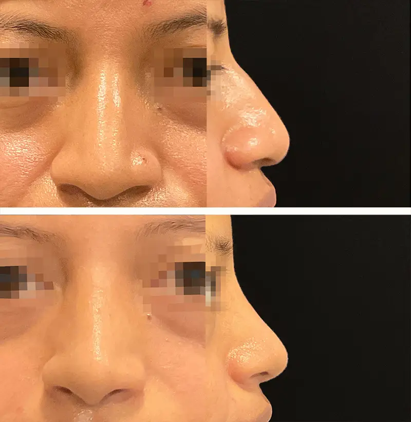 Patient54EthnicRhinoplastyBeforeAndAfterGallery