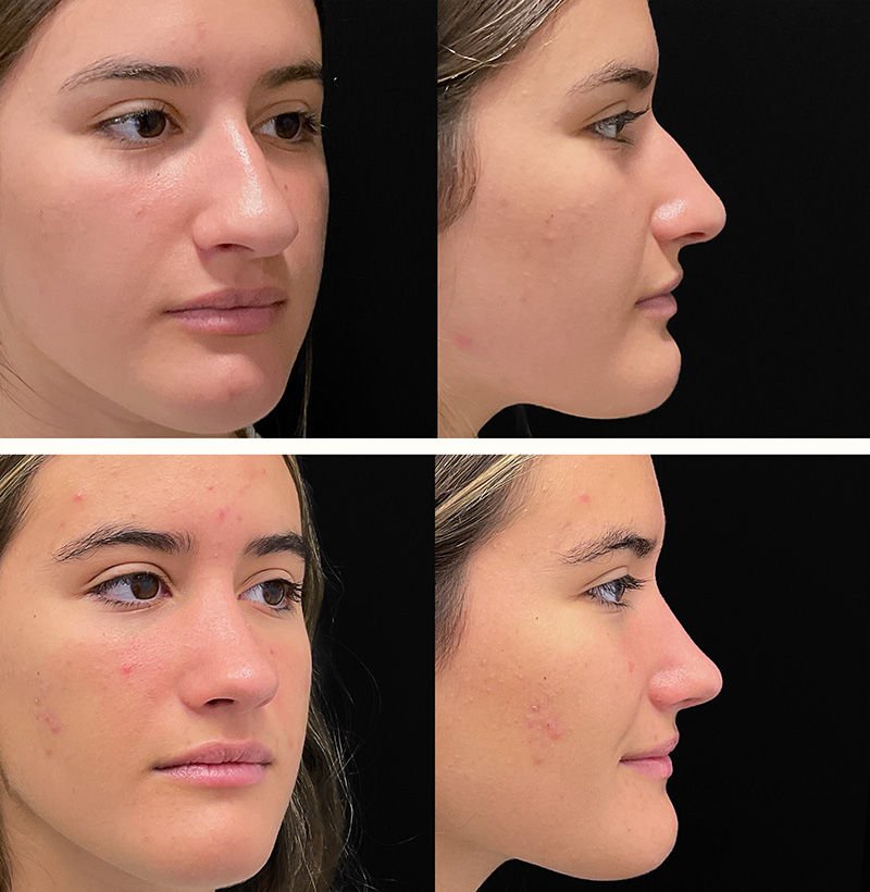 Patient76RhinoplastyBeforeAndAfterGallery
