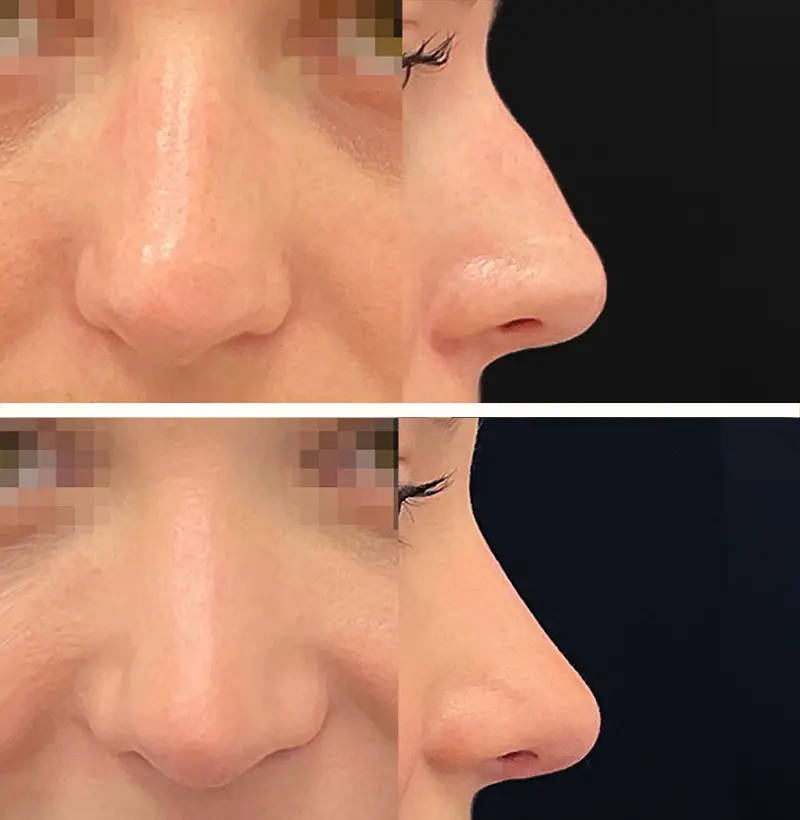 Patient82RhinoplastyBeforeAndAfterGallery
