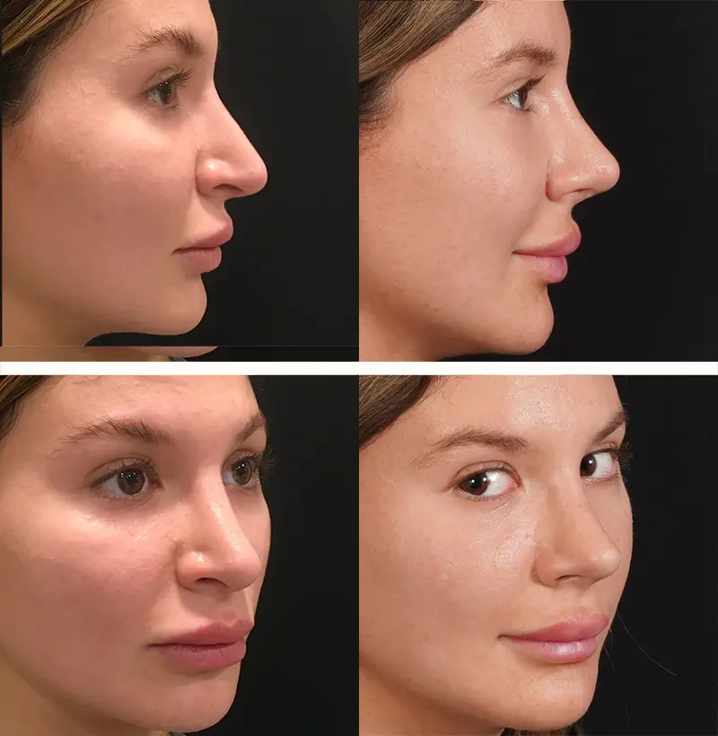 Patient86RevisionRhinoplastyBeforeAndAfterGallery
