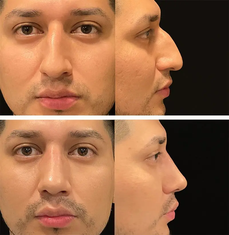 Patient91MaleRhinoplastyBeforeAndAfterGallery
